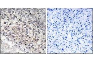 Immunohistochemistry analysis of paraffin-embedded human liver carcinoma tissue, using Cytochrome P450 2W1 Antibody.