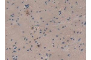 DAB staining on IHC-P; Samples: Human Colorectal cancer Tissue (SLURP1 Antikörper  (AA 1-103))