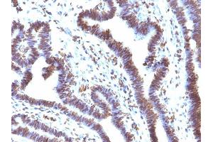 Formalin-fixed, paraffin-embedded human Ovarian Carcinoma stained with EMI1 Mouse Monoclonal Antibody (EMI1/1176). (FBXO5 Antikörper  (AA 1-250))