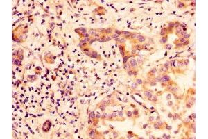 IHC image of ABIN7153857 diluted at 1:100 and staining in paraffin-embedded human liver cancer performed on a Leica BondTM system. (GLIPR1 Antikörper  (AA 22-232))