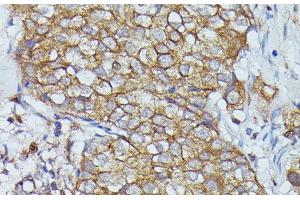 Immunohistochemistry of paraffin-embedded Human mammary cancer using CTTN Polyclonal Antibody at dilution of 1:100 (40x lens). (Cortactin Antikörper)