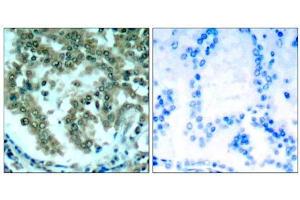 Immunohistochemical analysis of paraffin-embedded human lung carcinoma tissue, using PKCθ (Ab-676) antibody (E021289). (PKC theta Antikörper)