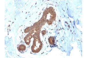 Formalin-fixed, paraffin-embedded human Breast Carcinoma stained with GSTMu2 Mouse Monoclonal Antibody (CPTC-GSTMu2-2). (GSTM4 Antikörper)