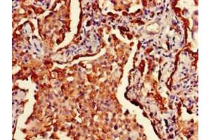 Immunohistochemistry of paraffin-embedded human lung cancer using ABIN7155618 at dilution of 1:100 (HLA-DRB1 Antikörper  (AA 31-266) (Biotin))