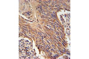 RDH10 Antibody (Center) (ABIN650935 and ABIN2840001) immunohistochemistry analysis in formalin fixed and paraffin embedded lung carcinoma followed by peroxidase conjugation of the secondary antibody and DAB staining. (RDH10 Antikörper  (AA 106-135))