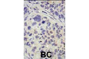 Formalin-fixed and paraffin-embedded human cancer tissue reacted with USP8 polyclonal antibody  , which was peroxidase-conjugated to the secondary antibody, followed by AEC staining . (USP8 Antikörper  (C-Term))