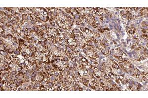 ABIN6279676 at 1/100 staining Human liver cancer tissue by IHC-P. (Kcne3 Antikörper  (Internal Region))