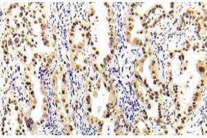 Immunohistochemistry (IHC) analyzes of STAT-5A antibody in paraffin-embedded human lung carcinoma tissue. (STAT5A Antikörper)