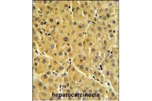 FBP1 Antibody (N-term) (ABIN391576 and ABIN2841511) IHC analysis in formalin fixed and paraffin embedded human hepatocarcinoma followed by peroxidase conjugation of the secondary antibody and DAB staining. (FBP1 Antikörper  (N-Term))