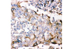 Anti- GFRA1 antibody, IHC(P) IHC(P): Human Lung Cancer Tissue (GFRA1 Antikörper  (AA 25-227))