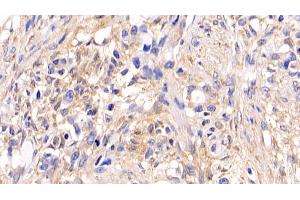 Detection of ERK1 in Human Ovarian cancer Tissue using Monoclonal Antibody to Extracellular Signal Regulated Kinase 1 (ERK1) (ERK1 Antikörper  (AA 75-312))