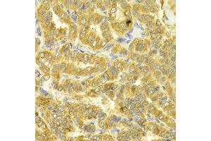 Immunohistochemistry of paraffin-embedded human thyroid cancer using DLD Antibody. (DLD Antikörper  (AA 36-300))