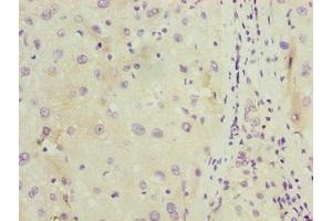 Immunohistochemistry of paraffin-embedded human liver cancer using ABIN7174715 at dilution of 1:100 (C11orf53 Antikörper  (AA 13-236))