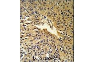 COG2 Antibody (N-term) (R) IHC analysis in formalin fixed and paraffin embedded human Lung carcinoma followed by peroxidase conjugation of the secondary antibody and DAB staining.