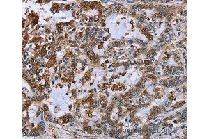 Immunohistochemistry of Human liver cancer using IMPDH2 Polyclonal Antibody at dilution of 1:60 (IMPDH2 Antikörper)