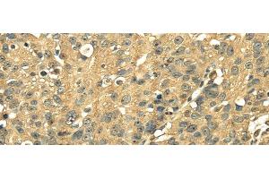 Immunohistochemistry of paraffin-embedded Human breast cancer using RPS3 Polyclonal Antibody at dilution of 1/25 (RPS3 Antikörper)