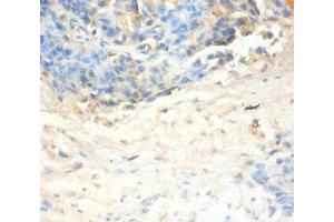 Immunohistochemistry of paraffin-embedded human ovarian cancer using ABIN7144333 at dilution of 1:100 (SLPI Antikörper  (AA 26-132))