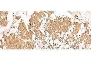 Immunohistochemistry of paraffin-embedded Human lung cancer tissue using MTHFD2L Polyclonal Antibody at dilution of 1:30(x200) (MTHFD2L Antikörper)