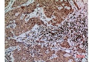 Immunohistochemistry (IHC) analysis of paraffin-embedded Human Mammary Cancer, antibody was diluted at 1:100. (CACYBP Antikörper  (C-Term))