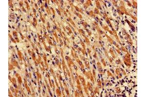 Immunohistochemistry of paraffin-embedded human liver cancer using ABIN7149048 at dilution of 1:100