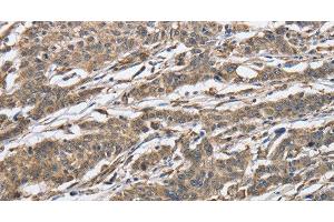 Immunohistochemistry of paraffin-embedded Human gastic cancer using IPO7 Polyclonal Antibody at dilution of 1:40 (IPO7 Antikörper)
