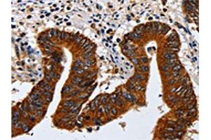 The image on the left is immunohistochemistry of paraffin-embedded Human colon cancer tissue using ABIN7130042(KRT23 Antibody) at dilution 1/20, on the right is treated with fusion protein. (KRT23 Antikörper)