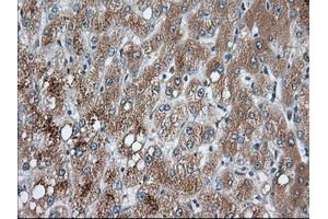 Immunohistochemical staining of paraffin-embedded Carcinoma of Human prostate tissue using anti-PANK2 mouse monoclonal antibody. (PANK2 Antikörper)
