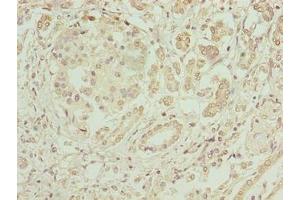 Immunohistochemistry of paraffin-embedded human pancreatic cancer using ABIN7152004 at dilution of 1:100 (ERO1LB Antikörper  (AA 101-400))