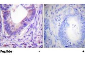 Immunohistochemical analysis of paraffin-embedded human colon carcinoma tissue using PRKACA polyclonal antibody .