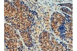TRIM24 polyclonal antibody  (4 ug/mL) staining of paraffin embedded human breast cancer. (TRIM24 Antikörper  (C-Term))