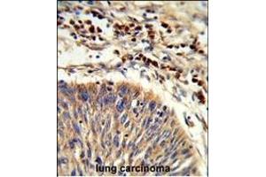 Formalin-fixed and paraffin-embedded human lung carcinoma reacted with HS Antibody (C-term), which was peroxidase-conjugated to the secondary antibody, followed by DAB staining. (HSPA6 Antikörper  (C-Term))