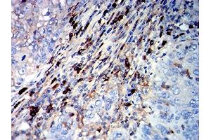 Immunohistochemical analysis of paraffin-embedded cervical cancer tissues using CD45R mouse mAb with DAB staining. (CD45 Antikörper  (AA 378-577))