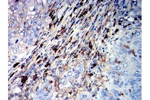 Immunohistochemical analysis of paraffin-embedded cervical cancer tissues using CD45R mouse mAb with DAB staining. (CD45 Antikörper  (AA 378-577))