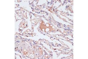 Immunohistochemistry of paraffin-embedded human lung using IFNG antibody (ABIN6128080, ABIN6142195, ABIN6142196 and ABIN6216082) at dilution of 1:100 (40x lens). (Interferon gamma Antikörper  (AA 24-166))