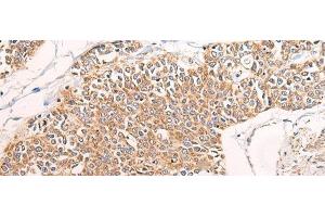 Immunohistochemistry of paraffin-embedded Human prost at e cancer tissue using C14orf2 Polyclonal Antibody at dilution of 1:60(x200) (C14orf2 Antikörper)