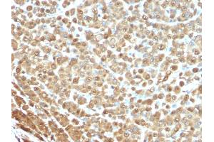 Formalin-fixed, paraffin-embedded human Melanoma stained with S100A1 Mouse Monoclonal Antibody (S1/61) (S100A1 Antikörper)