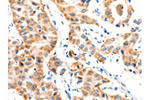 The image on the left is immunohistochemistry of paraffin-embedded Human lung cancer tissue using ABIN7191765(PAFAH1B1 Antibody) at dilution 1/25, on the right is treated with synthetic peptide. (PAFAH1B1 Antikörper)