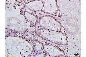 Formalin-fixed and paraffin embedded: human colon carcinoma labeled with Anti-MTLC Polyclonal Antibody (ABIN728015), Unconjugated at 1:200, followed by conjugation to the secondary antibody and DAB staining (Myc Target 1 Antikörper  (AA 21-100))