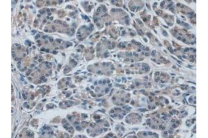 IHC-P analysis of Human Pancreas Cancer Tissue, with DAB staining. (IDE Antikörper  (AA 753-973))