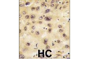 Formalin-fixed and paraffin-embedded human hepatocarcinoma tissue reacted with PROX1 antibody (Center), which was peroxidase-conjugated to the secondary antibody, followed by DAB staining. (PROX1 Antikörper  (AA 185-214))