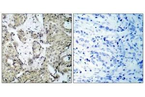 Immunohistochemical analysis of paraffin- embedded human breast carcinoma tissue, using MKK3 (phospho-Ser189) antibody (E011145). (MAP2K3 Antikörper  (pSer189))