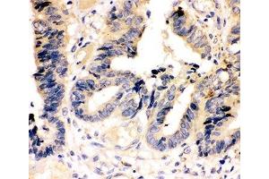 IHC-P: Caspase-7 antibody testing of human intestinal cancer tissue (Caspase 7 Antikörper  (AA 237-255))