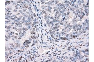 Immunohistochemical staining of paraffin-embedded Adenocarcinoma of colon tissue using anti-PPP5Cmouse monoclonal antibody. (PP5 Antikörper)