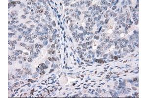Immunohistochemical staining of paraffin-embedded Adenocarcinoma of colon tissue using anti-PPP5Cmouse monoclonal antibody. (PP5 Antikörper)