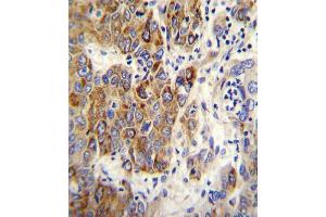 CYP2B6 Antibody (Center) (ABIN655056 and ABIN2844685) immunohistochemistry analysis in formalin fixed and paraffin embedded human hepatocarcinoma followed by peroxidase conjugation of the secondary antibody and DAB staining.