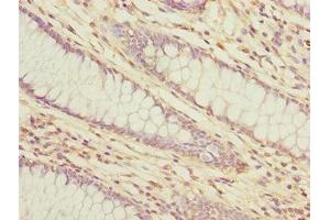 Immunohistochemistry of paraffin-embedded human colon cancer using ABIN7158367 at dilution of 1:100 (LMO4 Antikörper  (AA 1-165))