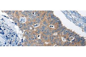 Immunohistochemistry of paraffin-embedded Human colorectal cancer tissue using RTN4IP1 Polyclonal Antibody at dilution of 1:50(x200) (RTN4IP1 Antikörper)