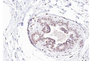 ABIN6267275 at 1/100 staining human Breast carcinoma tissue sections by IHC-P. (Estrogen Receptor alpha Antikörper  (pTyr537))