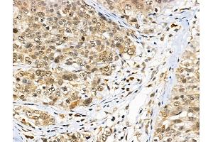 ABIN6260147 and ABIN6266767 at 1/100 staining Human pancreatic cancer by IHC-P. (ATRX Antikörper  (N-Term))