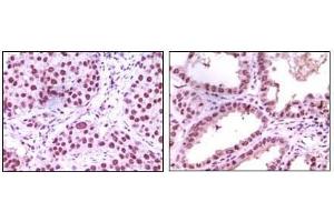 Immunohistochemical analysis of paraffin-embedded human lung carcinoma (left) and kidney carcinoma (right), showing nuclear localization using LSD1 antibody with DAB staining. (LSD1 Antikörper)